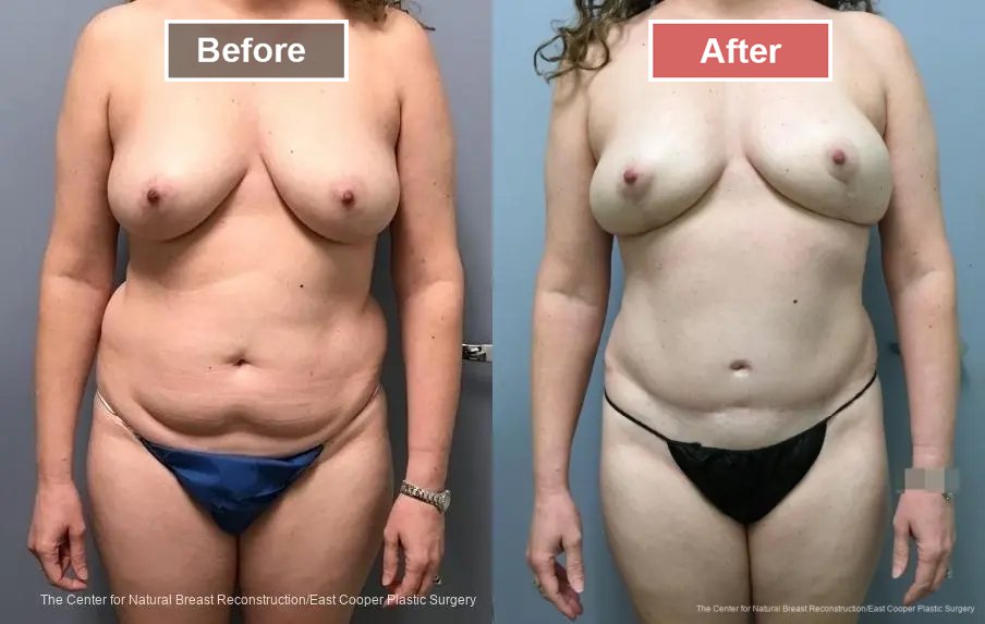 Breast Reconstruction DIEP- Before and After -10