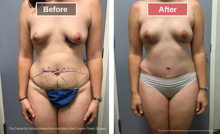 Breast Reconstruction DIEP- Before and After -11