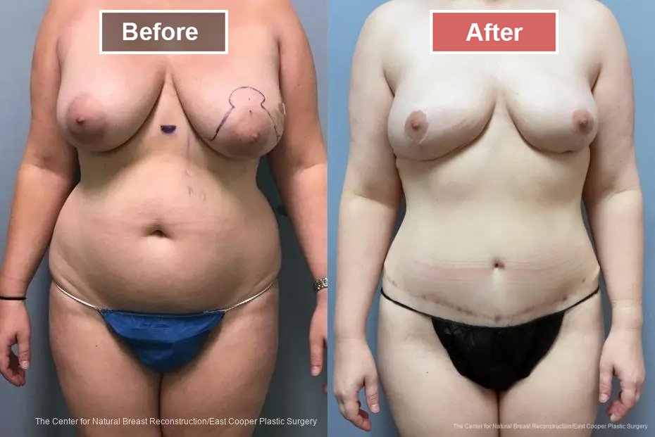 Breast Reconstruction DIEP- Before and After -12