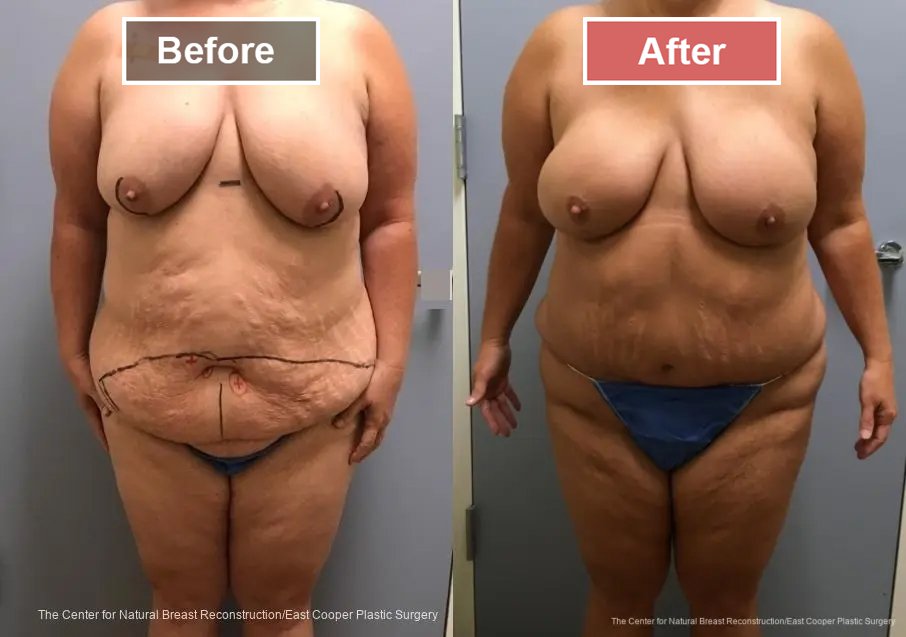 Breast Reconstruction DIEP- Before and After -14