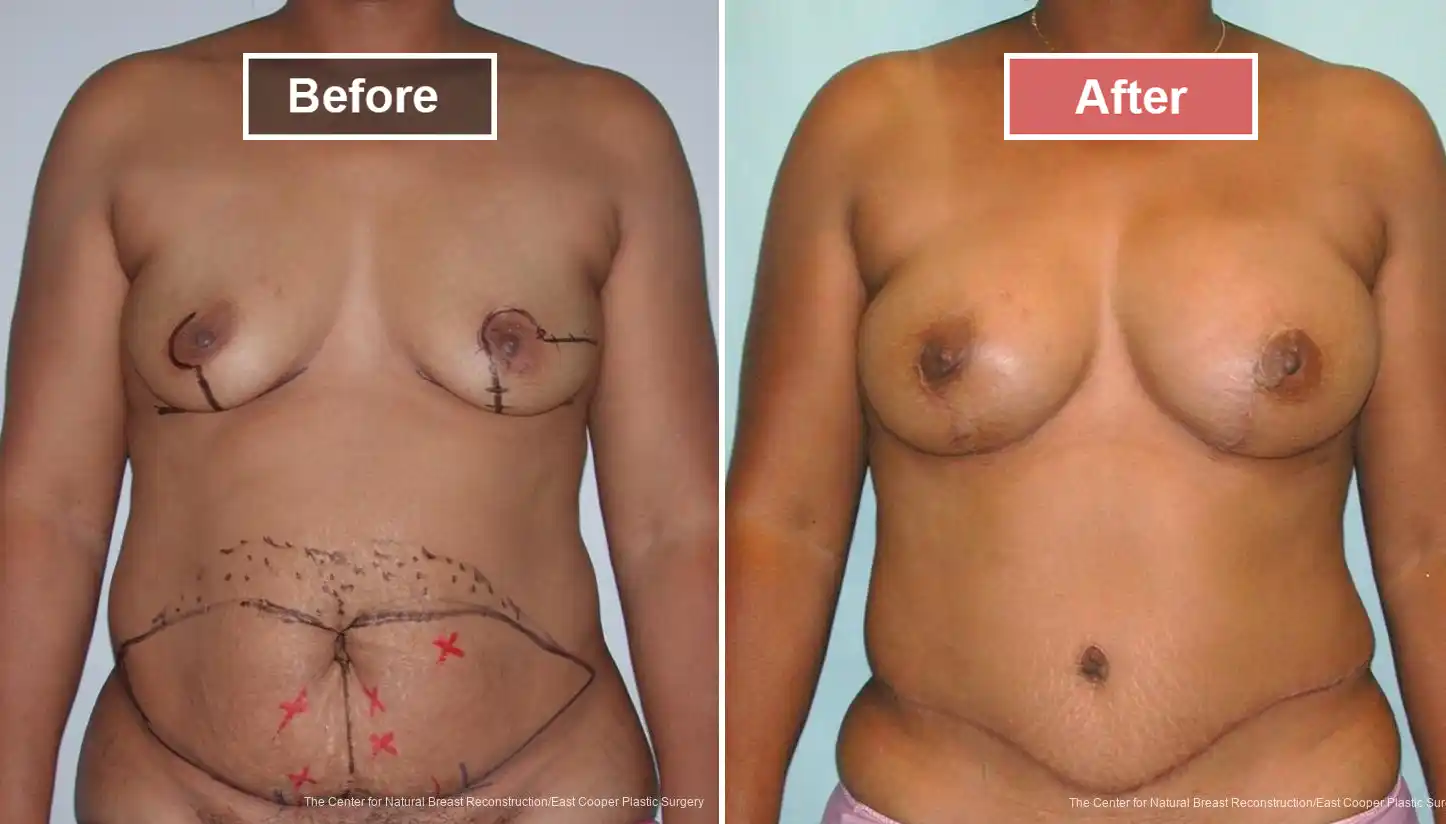 Breast Reconstruction DIEP- Before and After -17