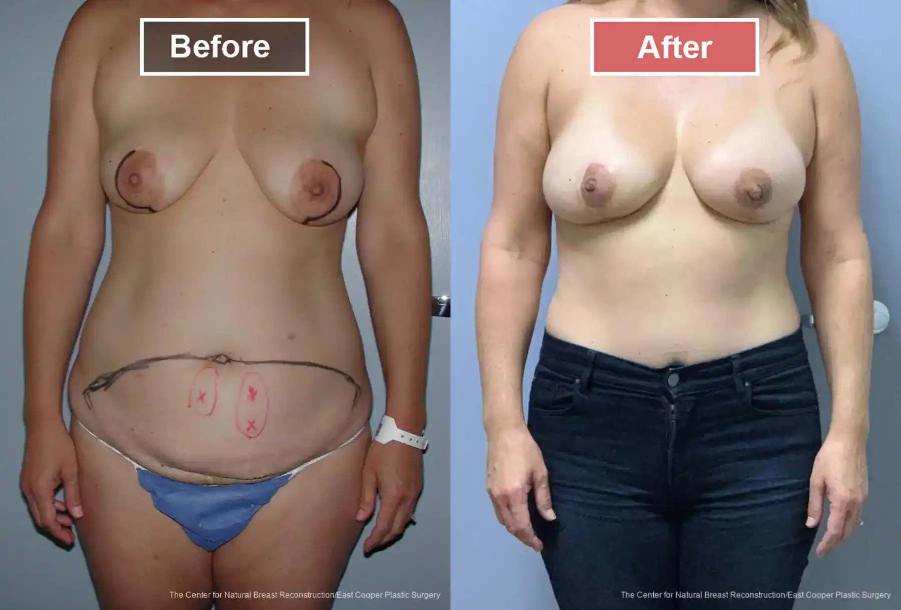 Breast Reconstruction DIEP- Before and After -18