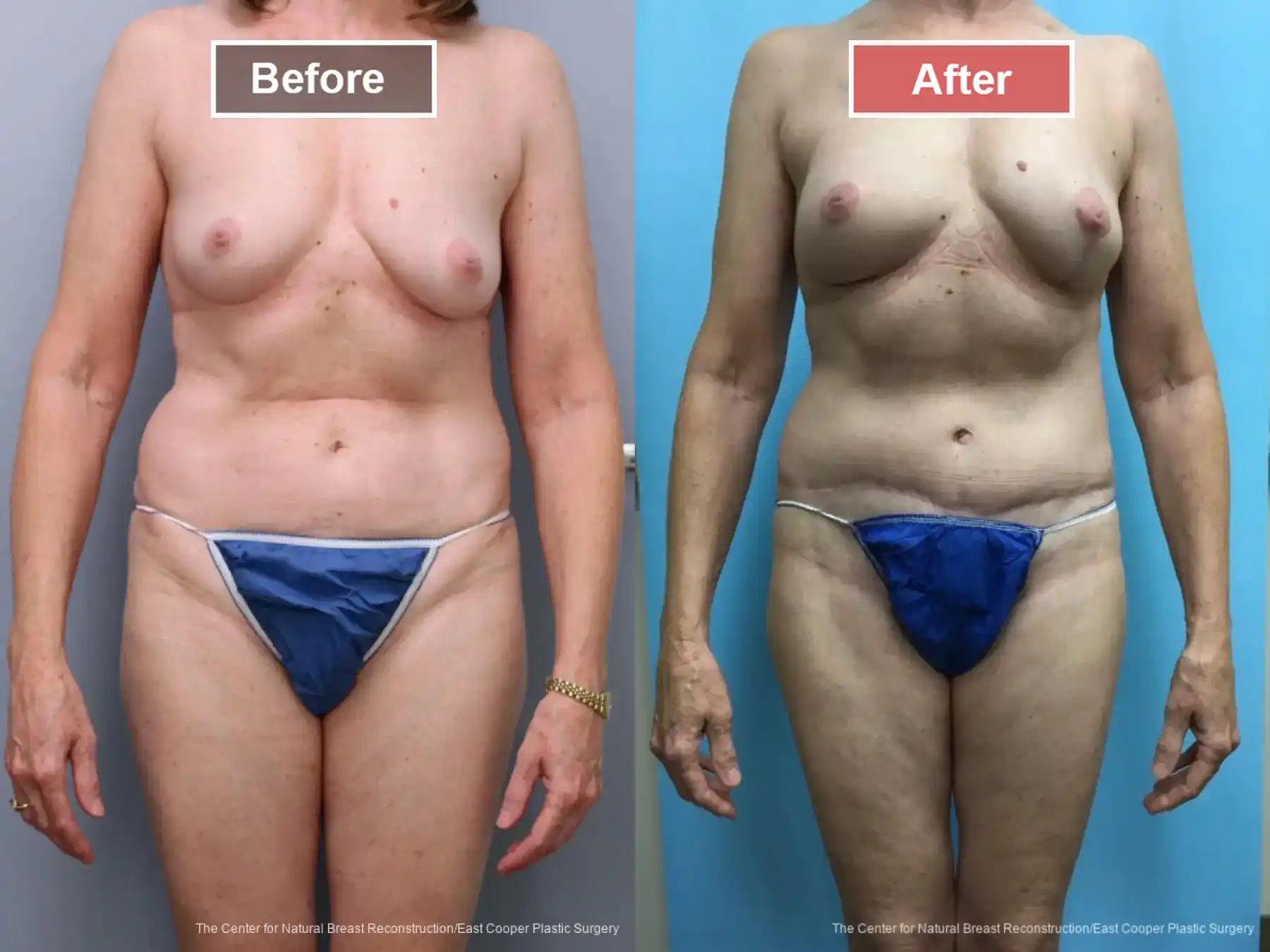 Breast Reconstruction DIEP- Before and After -19