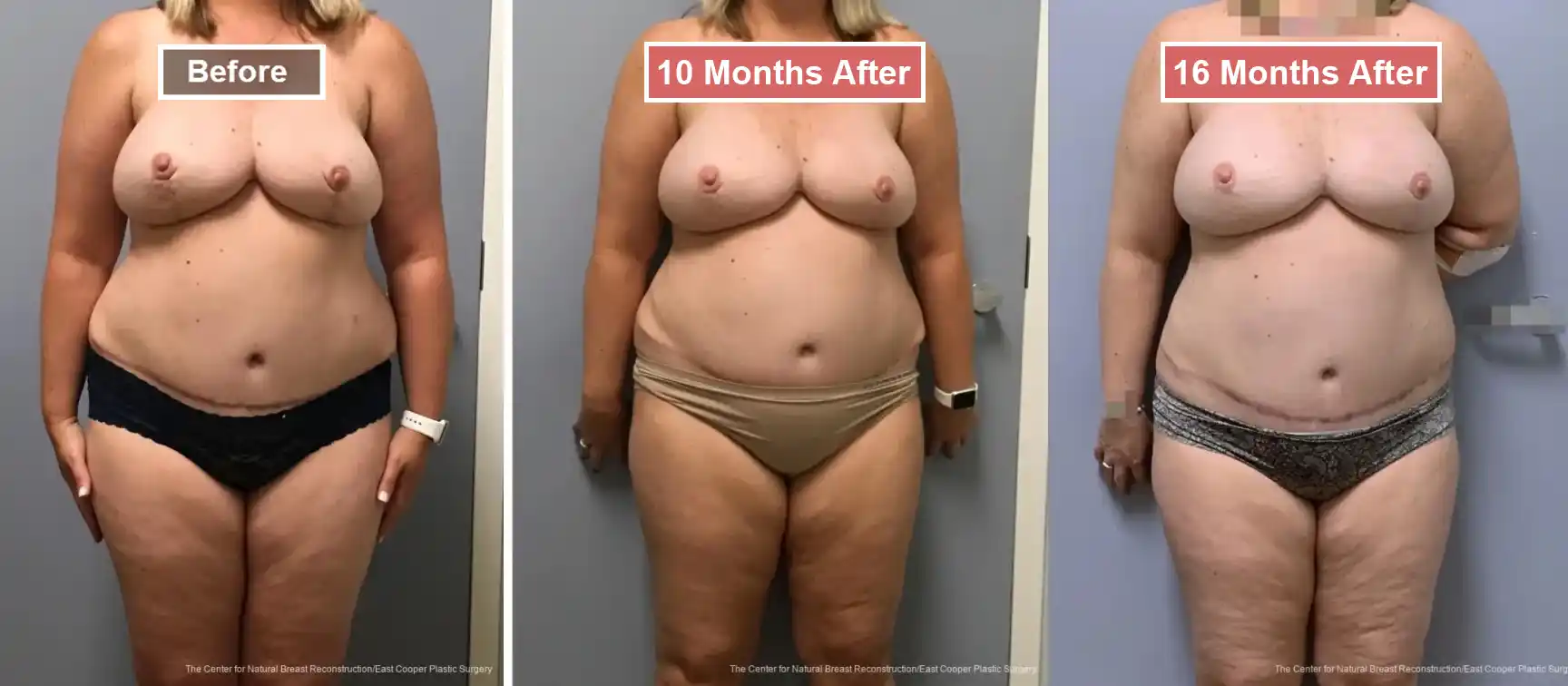 Breast Reconstruction DIEP- Before and After -20