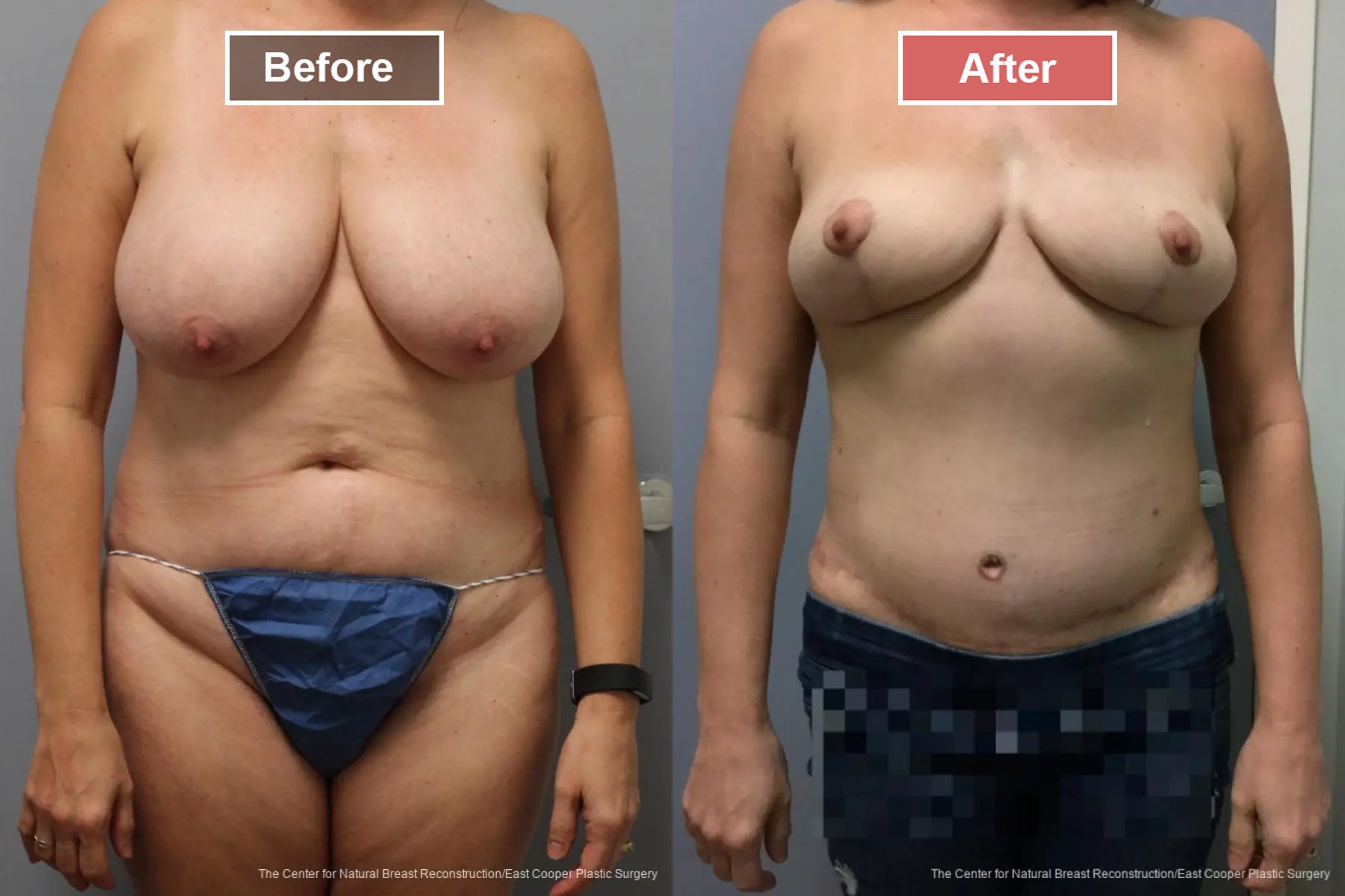 Breast Reconstruction DIEP- Before and After -21