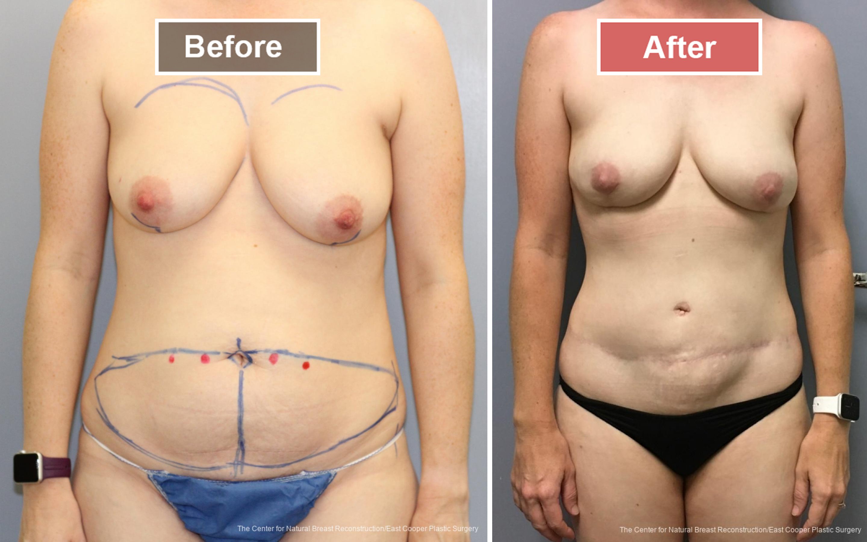 Breast Reconstruction DIEP- Before and After -22