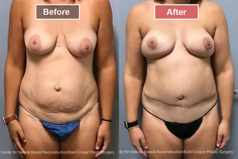 Breast Reconstruction DIEP- Before and After -23