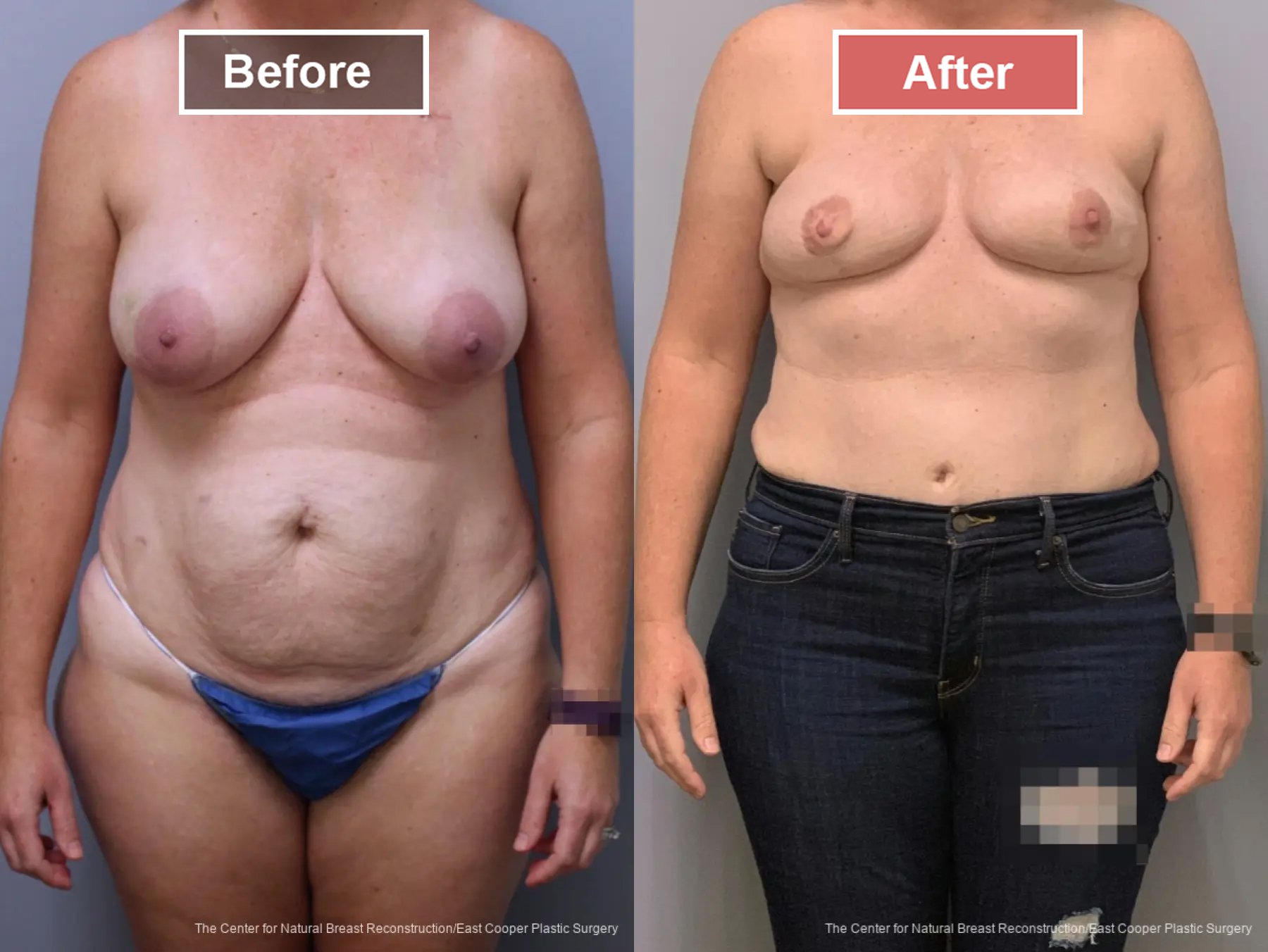 Breast Reconstruction DIEP- Before and After -24