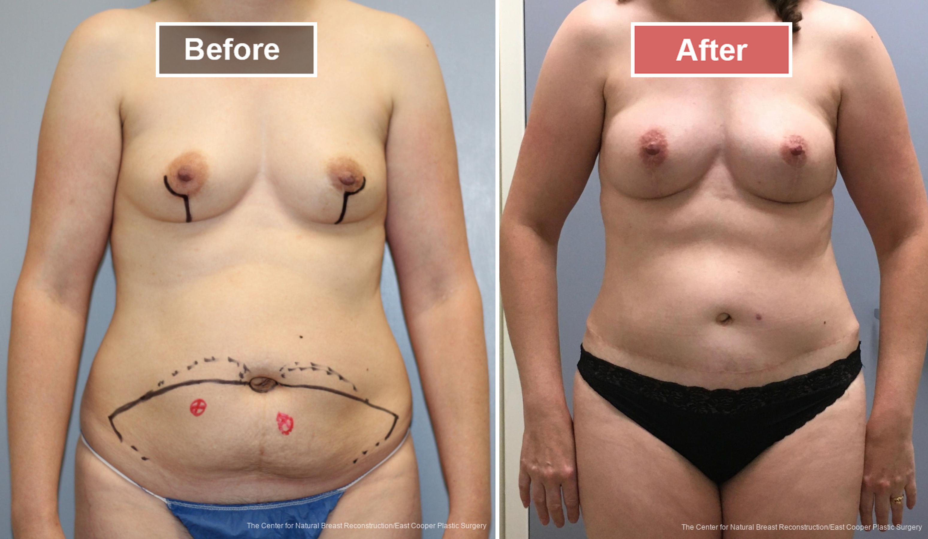 Breast Reconstruction DIEP- Before and After -25