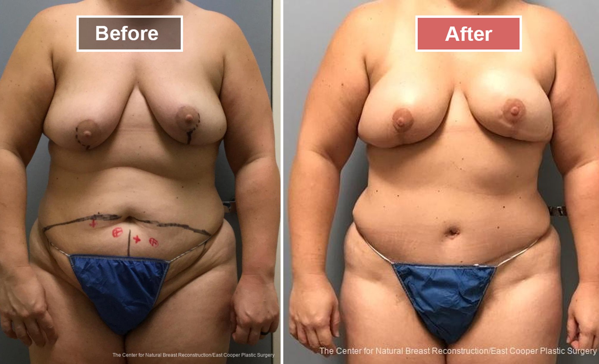 Breast Reconstruction DIEP- Before and After -26