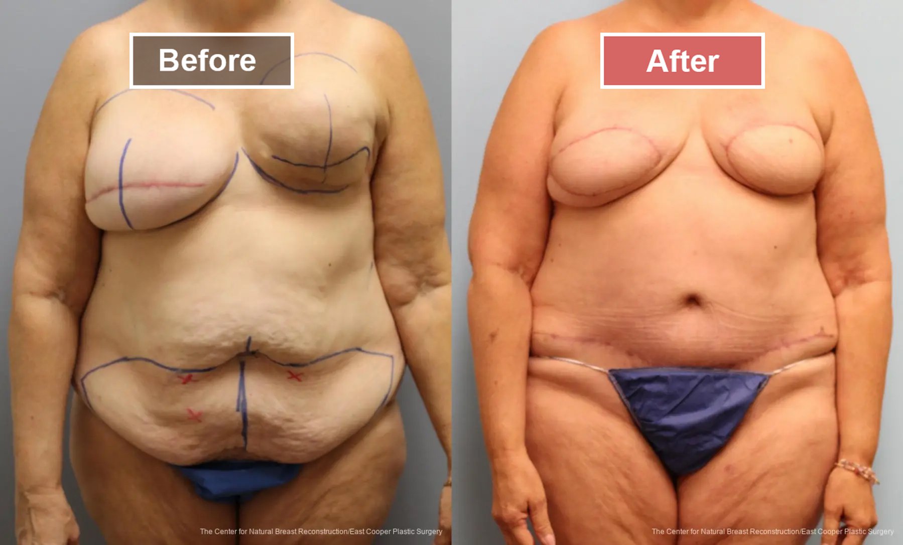 Breast Reconstruction DIEP- Before and After -27