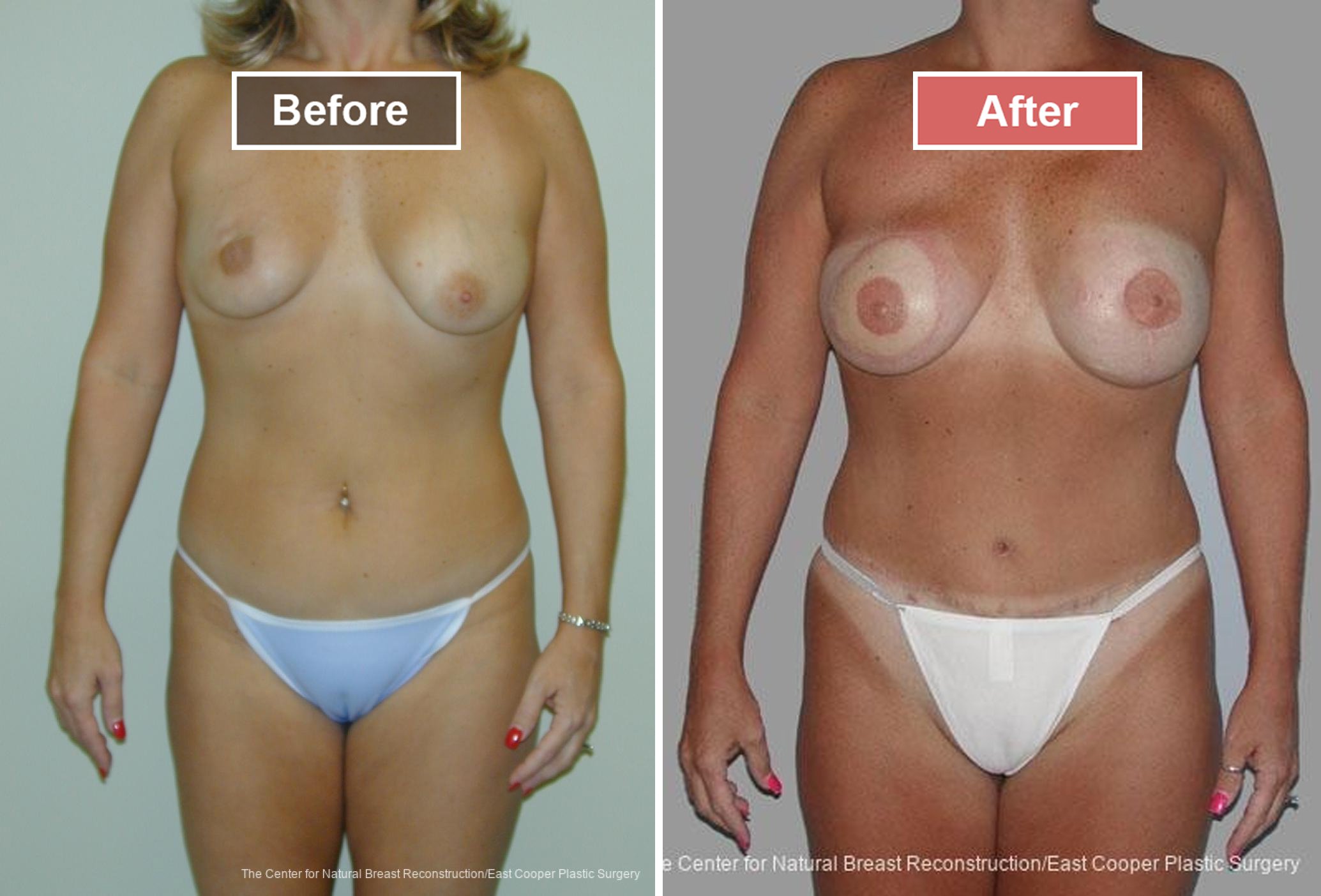 Breast Reconstruction DIEP- Before and After -28