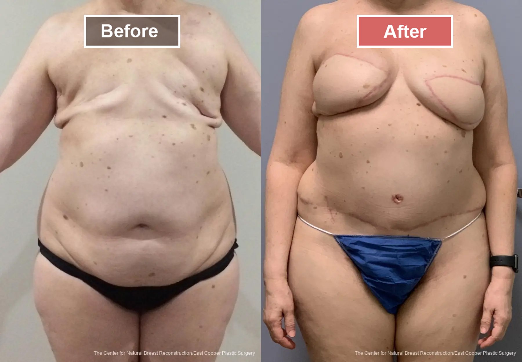 Breast Reconstruction DIEP- Before and After -29