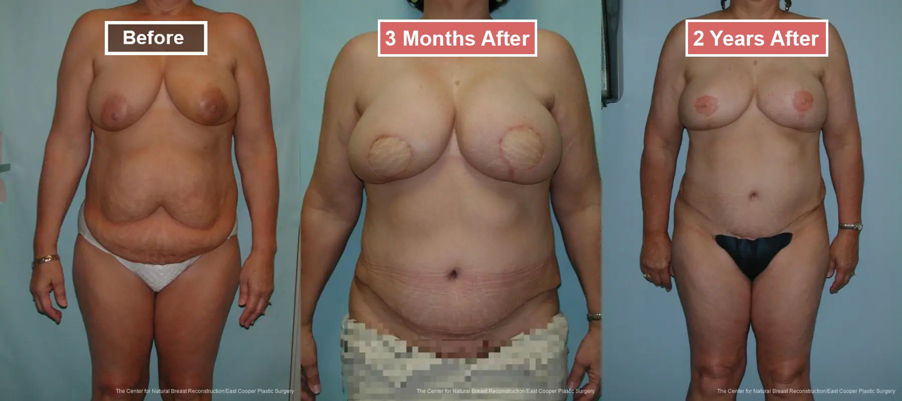 Breast Reconstruction DIEP- Before and After -30