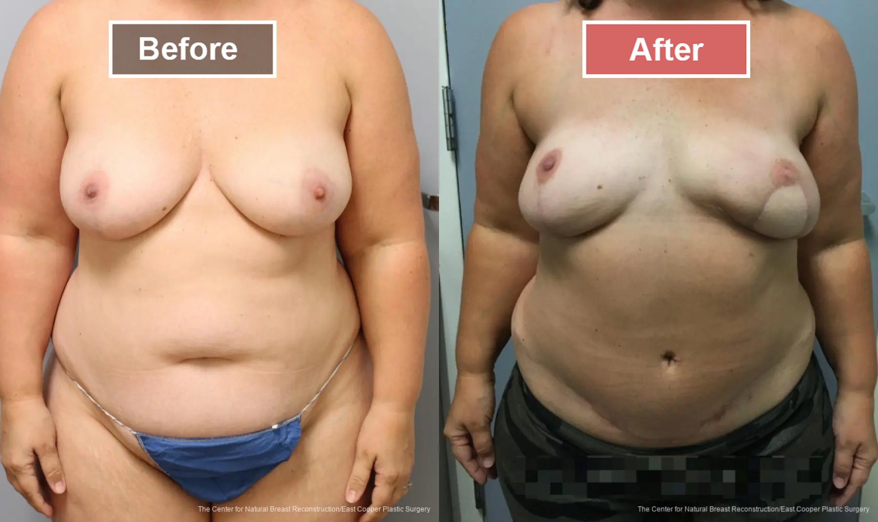 Breast Reconstruction DIEP- Before and After -31