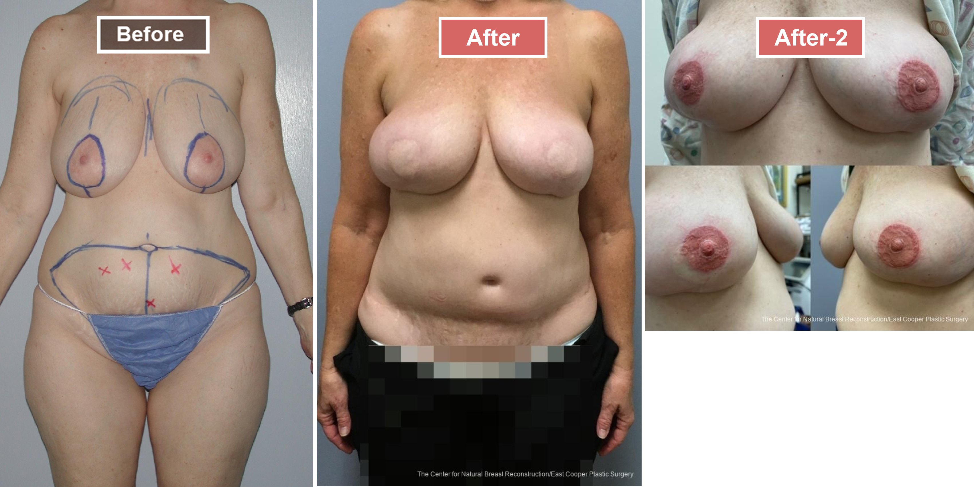 Breast Reconstruction DIEP- Before and After -32