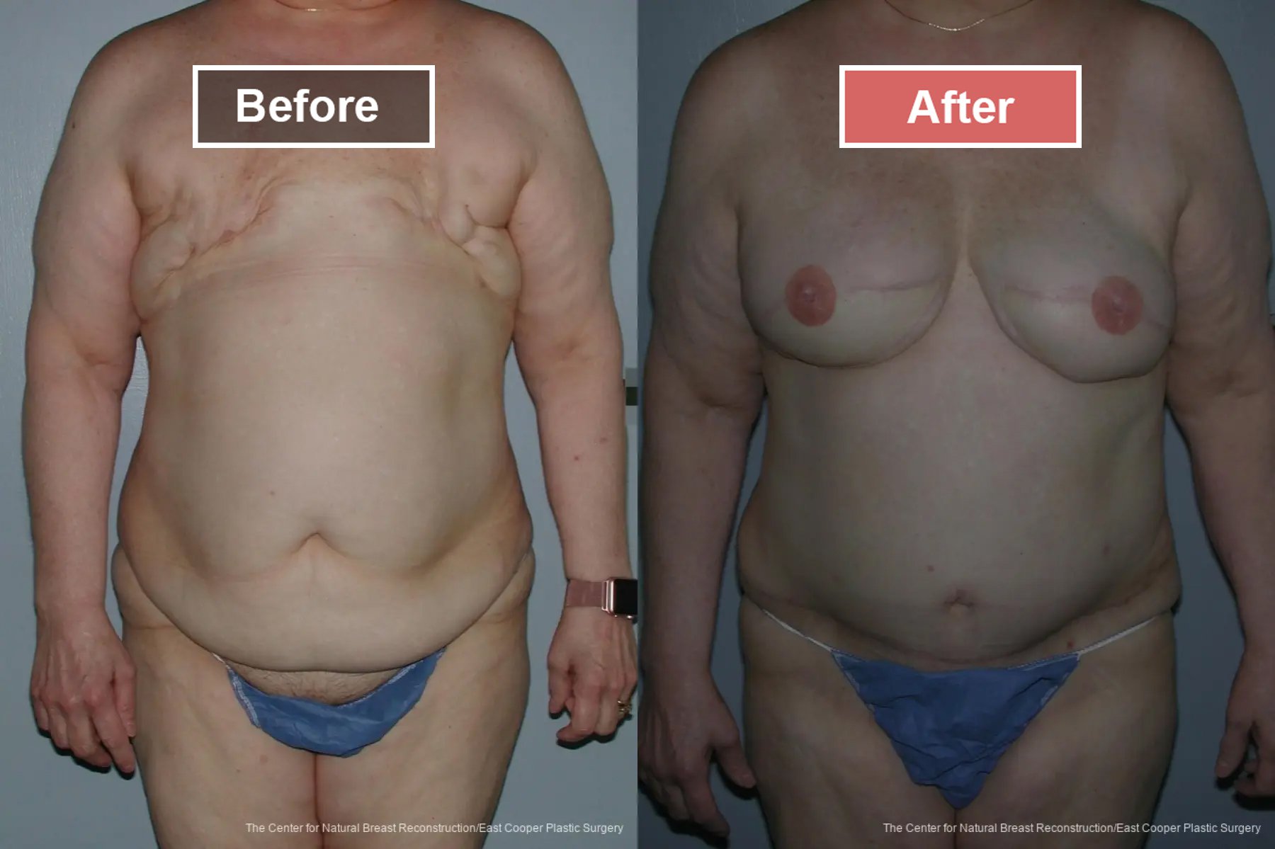 Breast Reconstruction DIEP- Before and After -33