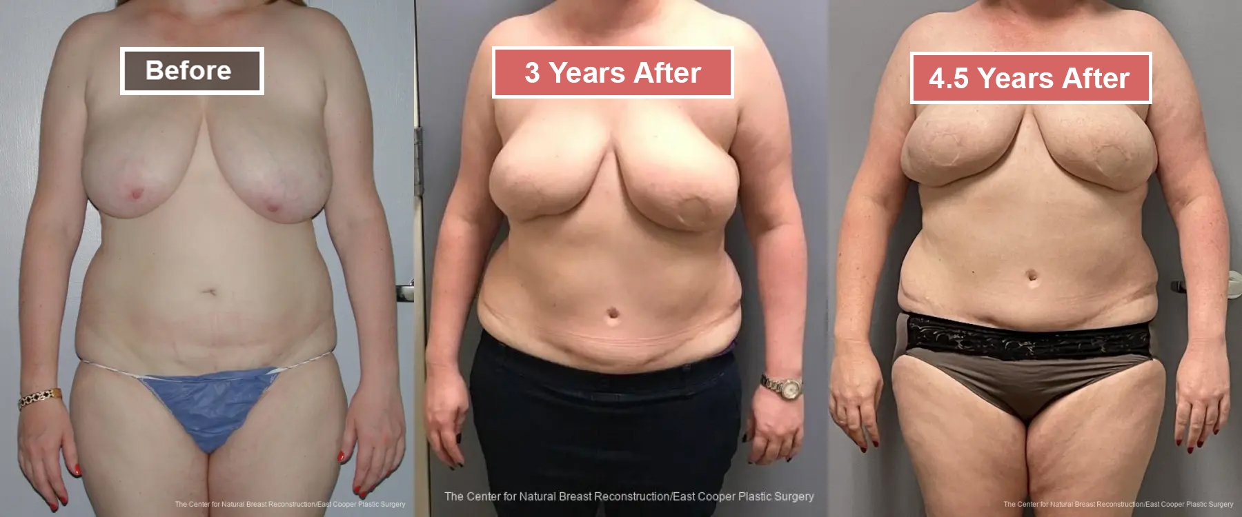 Breast Reconstruction DIEP- Before and After -34