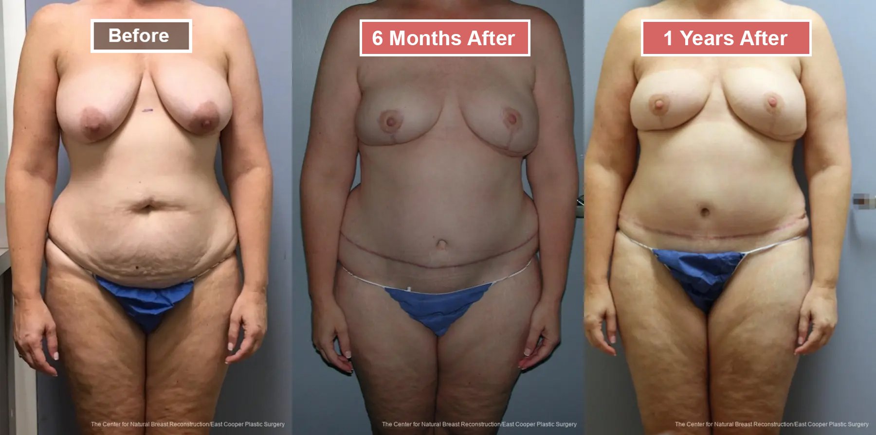 Breast Reconstruction DIEP- Before and After -36