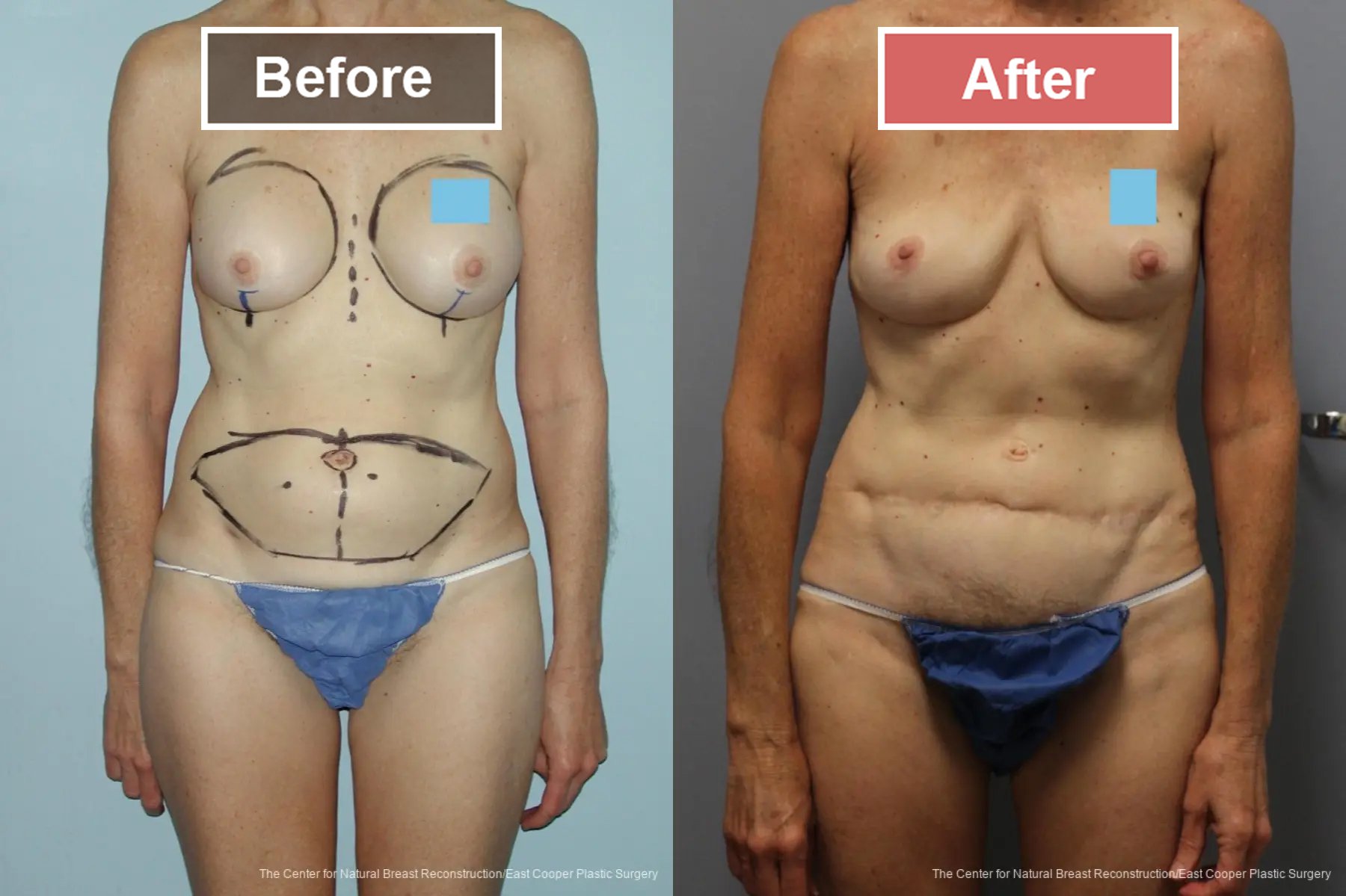 Breast Reconstruction DIEP- Before and After -37