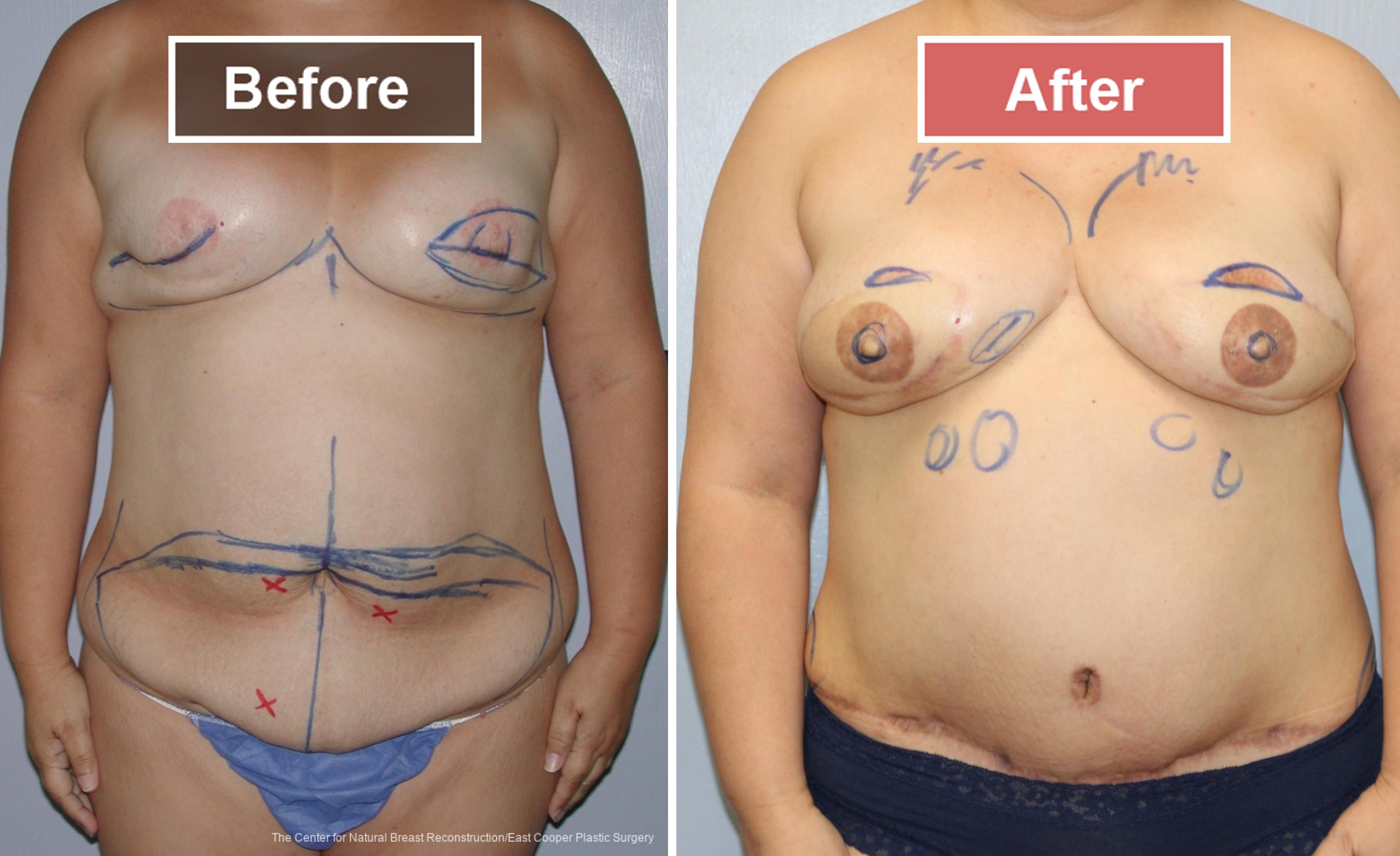 Breast Reconstruction DIEP- Before and After -39