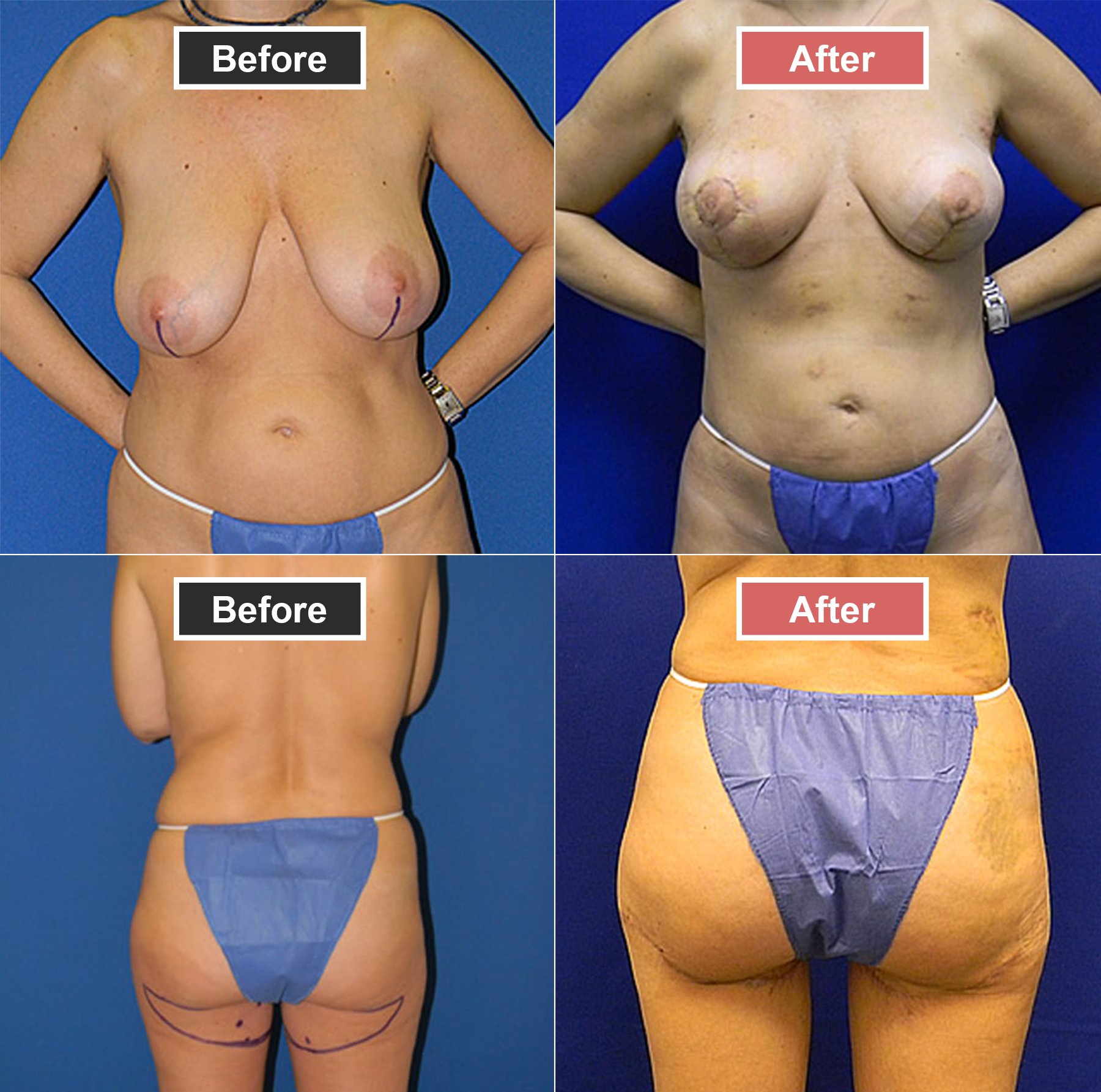 Breast Augmentation PAP Before and After -1