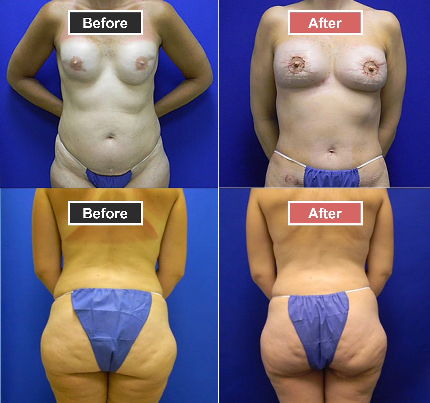 Breast Augmentation PAP Before and After -2