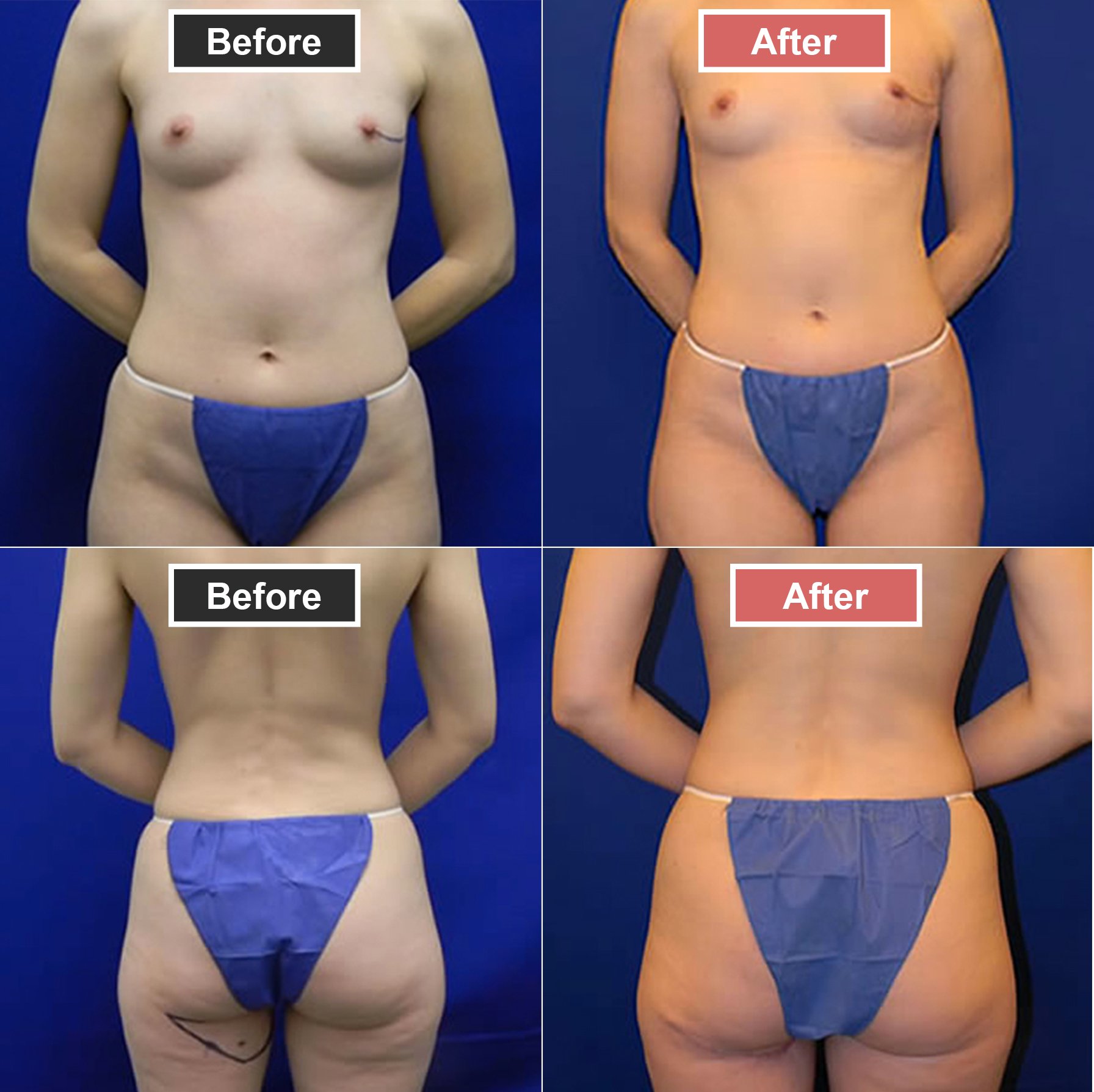 Breast Augmentation PAP Before and After -3