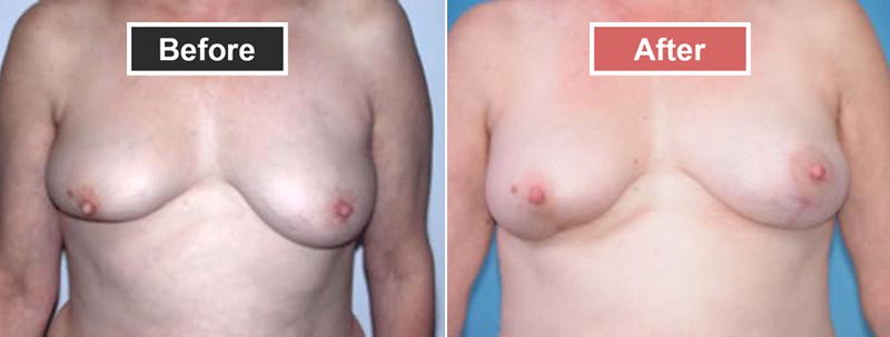 Breast Augmentation treatment before and after