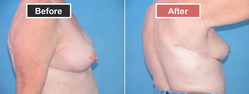 Breast Augmentation before and after