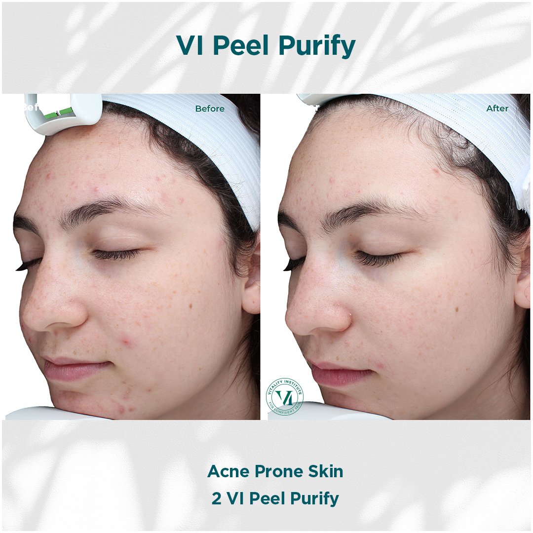 VI Peel treatment before and after - 10