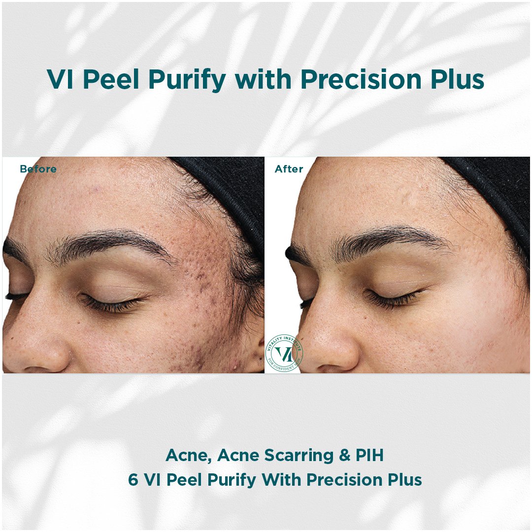 VI Peel treatment before and after - 4