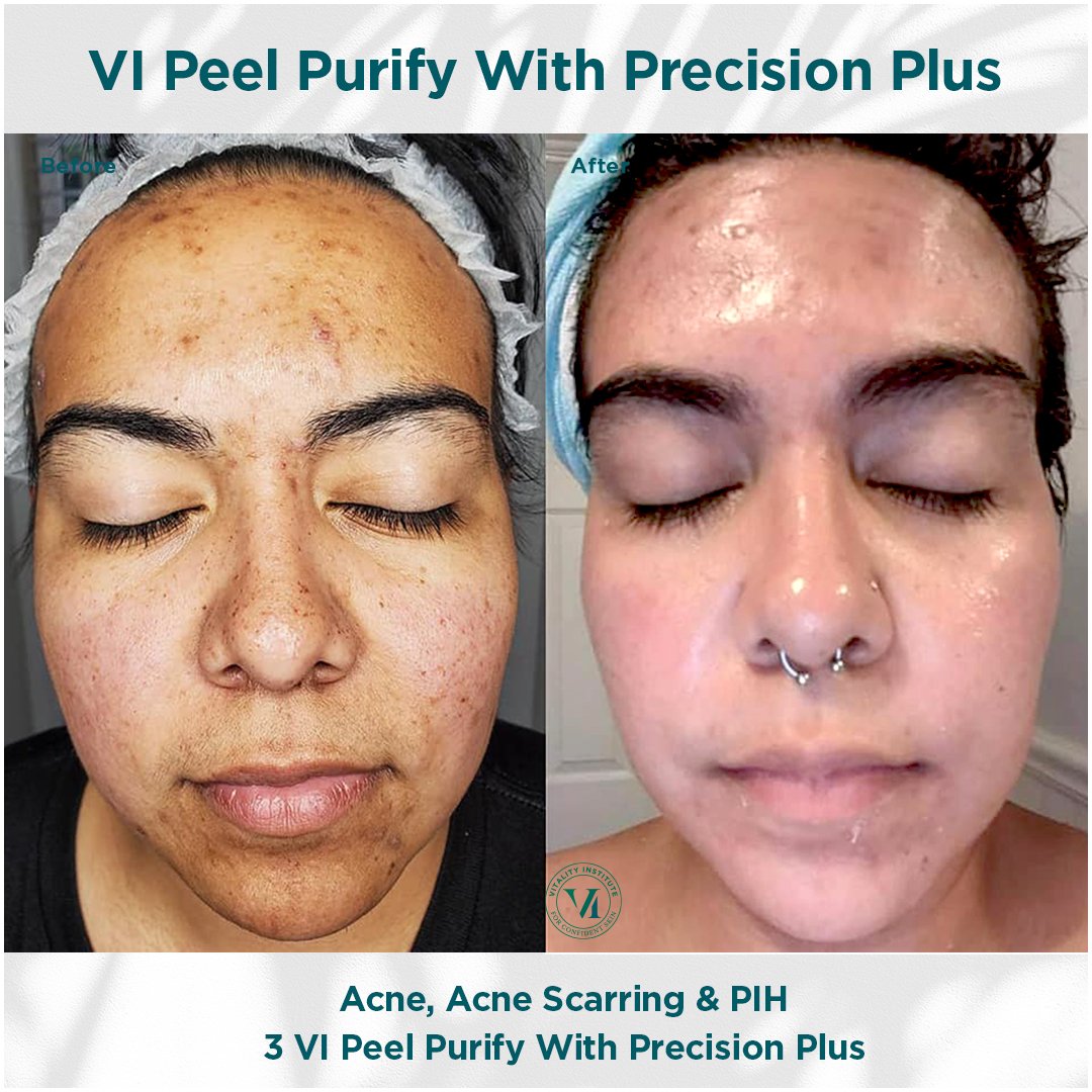 VI Peel treatment before and after - 2