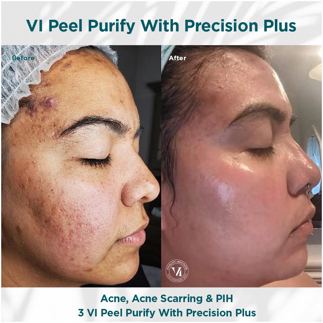 VI Peel treatment before and after - 3