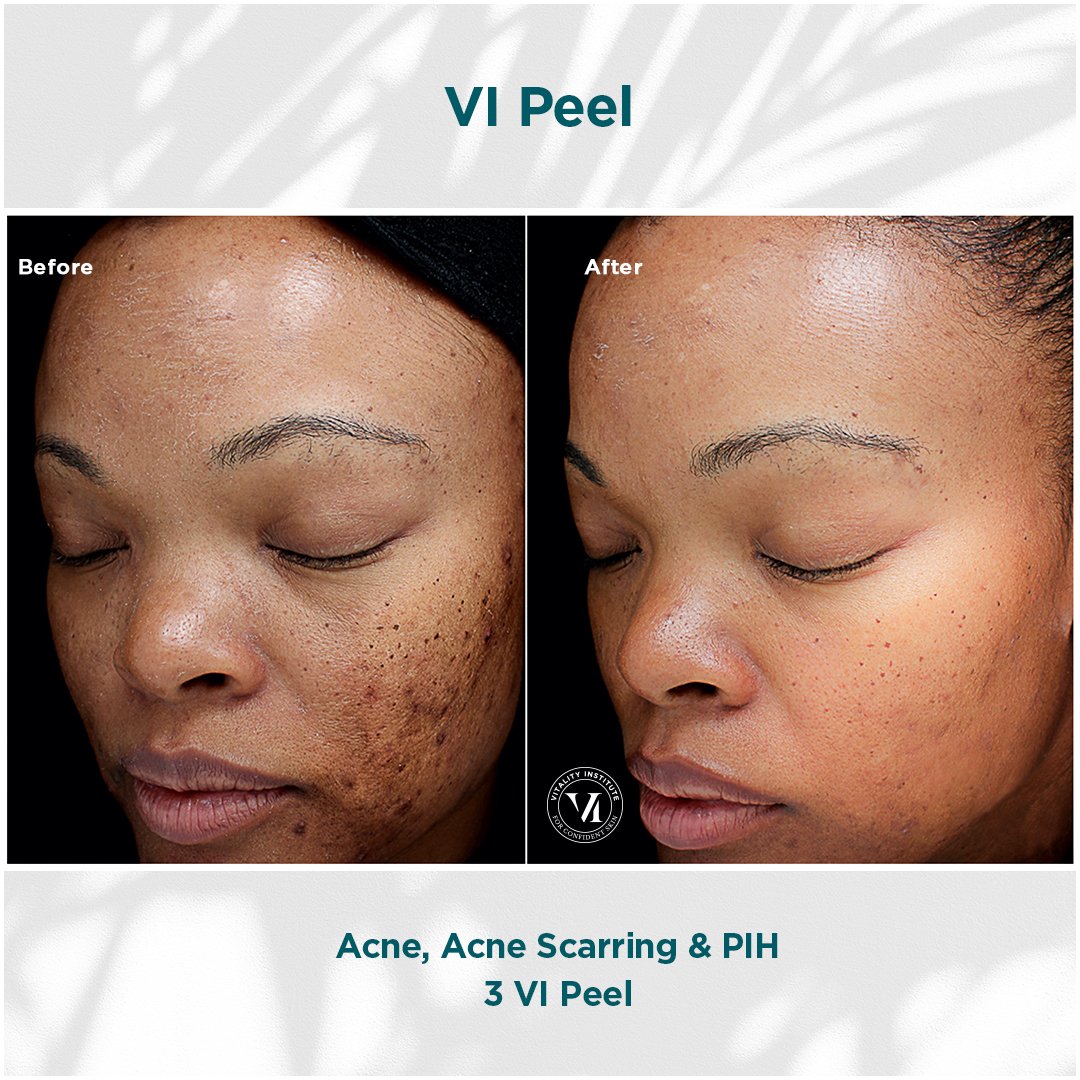 VI Peel treatment before and after - 18