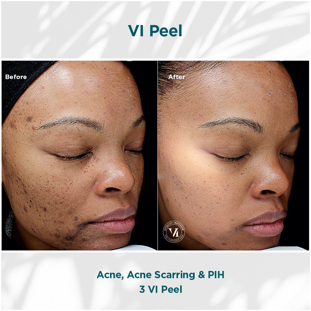 VI Peel treatment before and after - 19