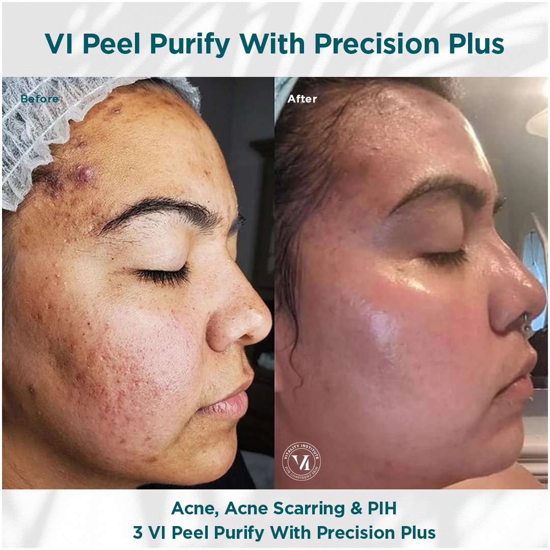 VI Peel treatment before and after - 22