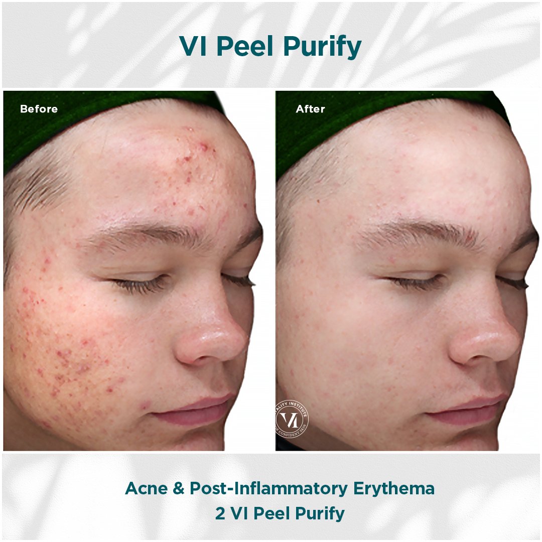 VI Peel treatment before and after - 21