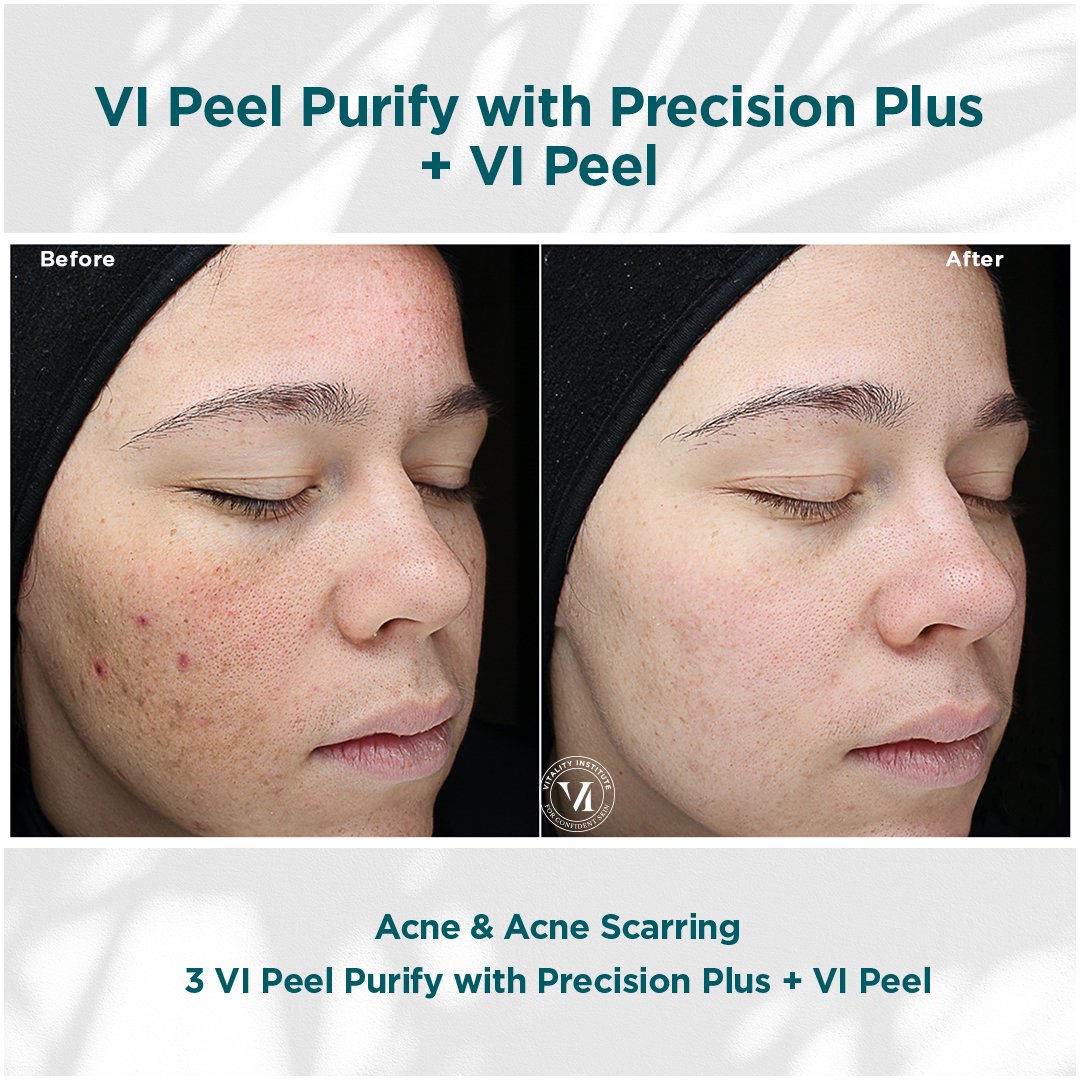 VI Peel treatment before and after - 5