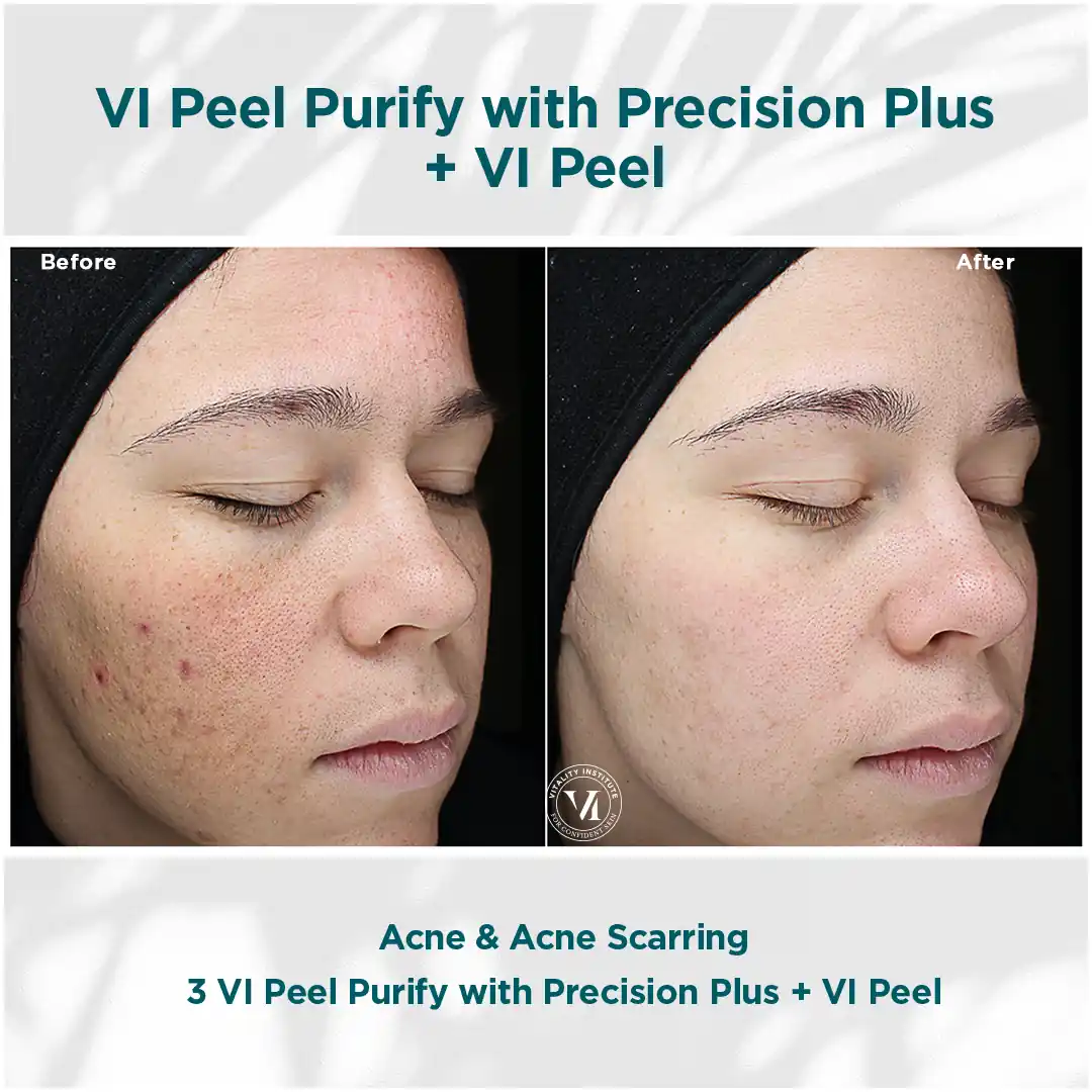 VI Peel 6