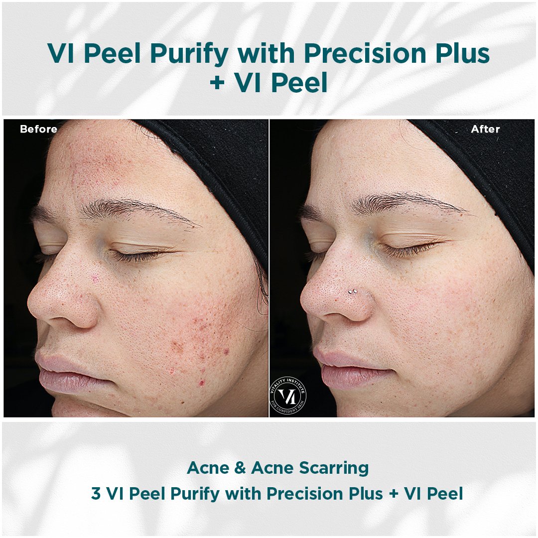 VI Peel treatment before and after - 7