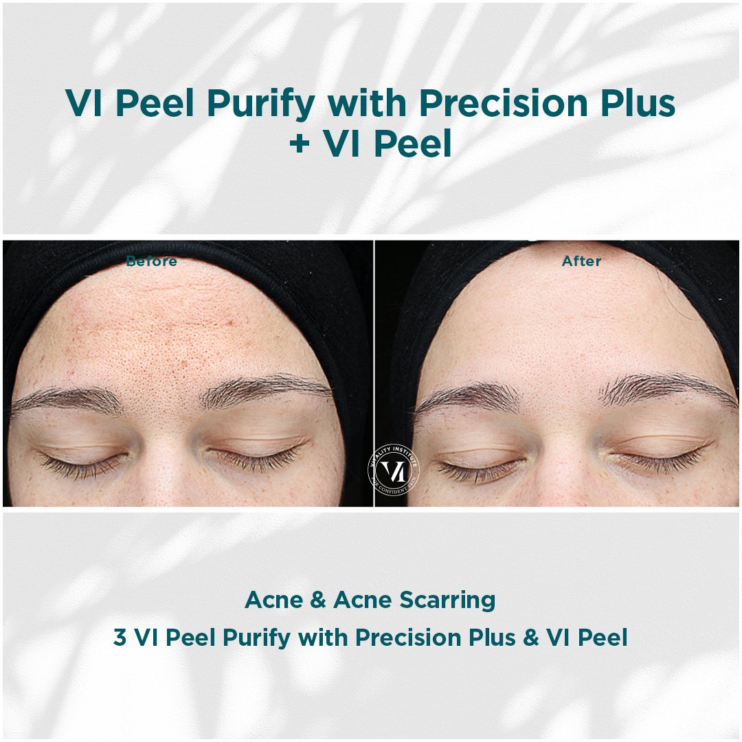 VI Peel treatment before and after - 8