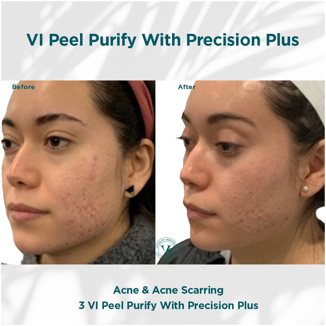 VI Peel treatment before and after - 5