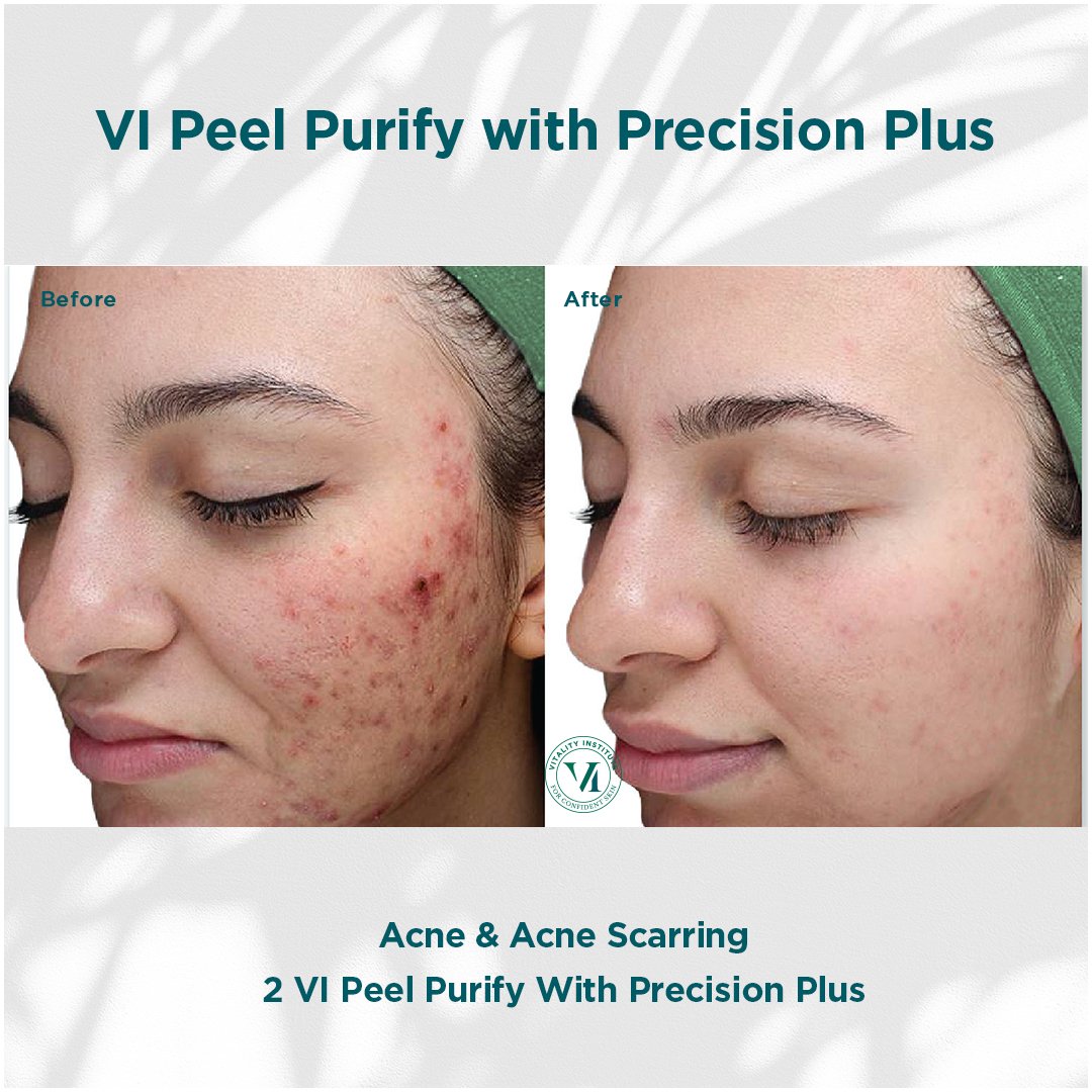 VI Peel treatment before and after - 20