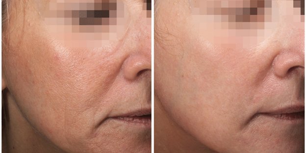 Collagen P.I.N. treatment before and after - 17