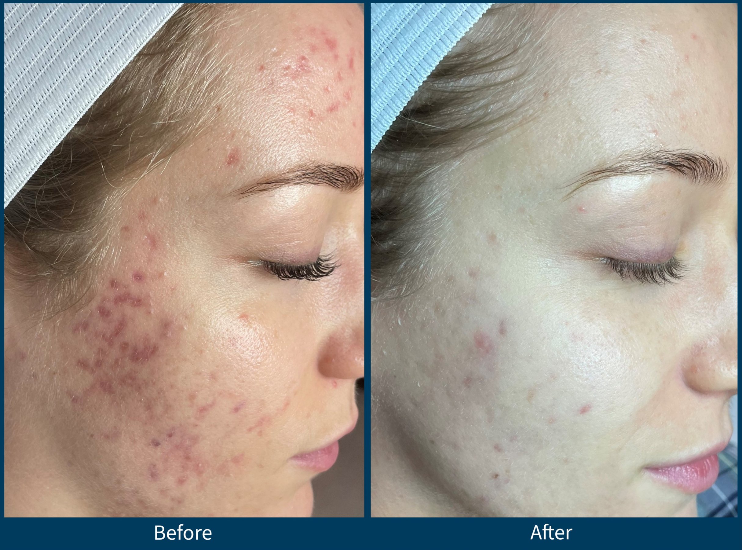 VI Peel treatment before and after - 24