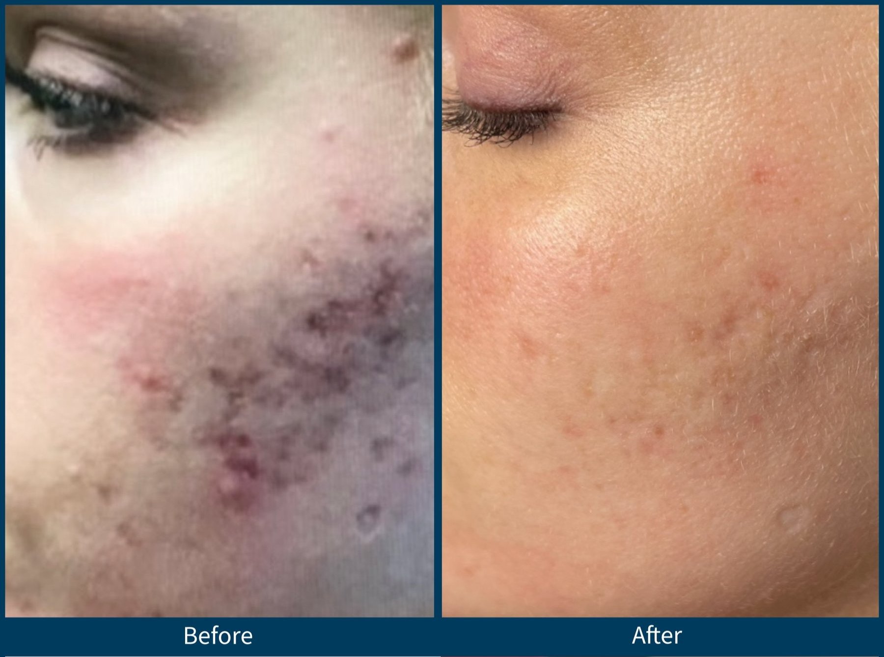 VI Peel treatment before and after - 23