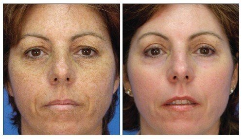 Collagen P.I.N. treatment before and after - 15