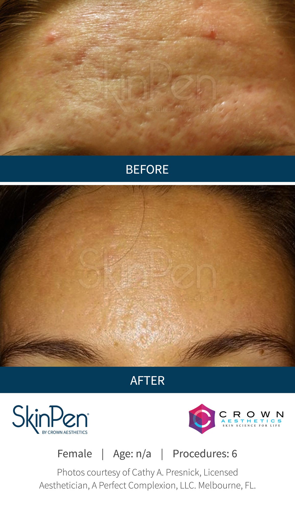 Hydrafacial treatment before and after - 4