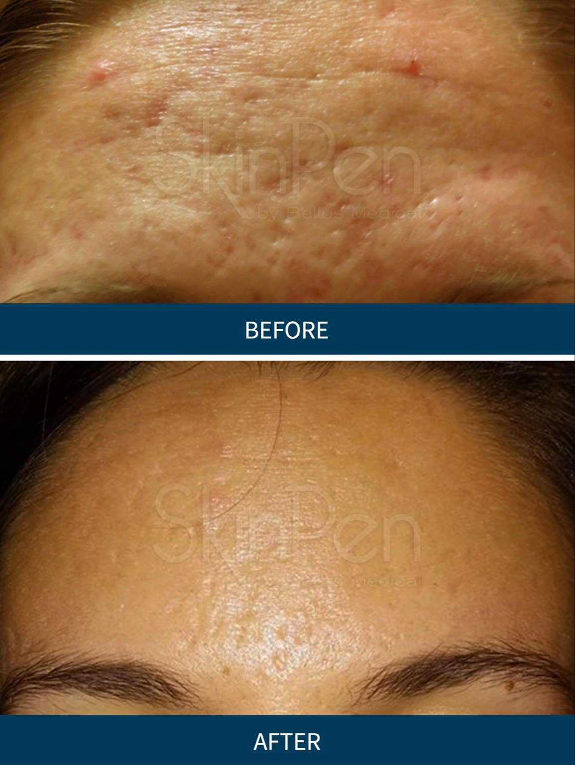 VI Peel treatment before and after - 25